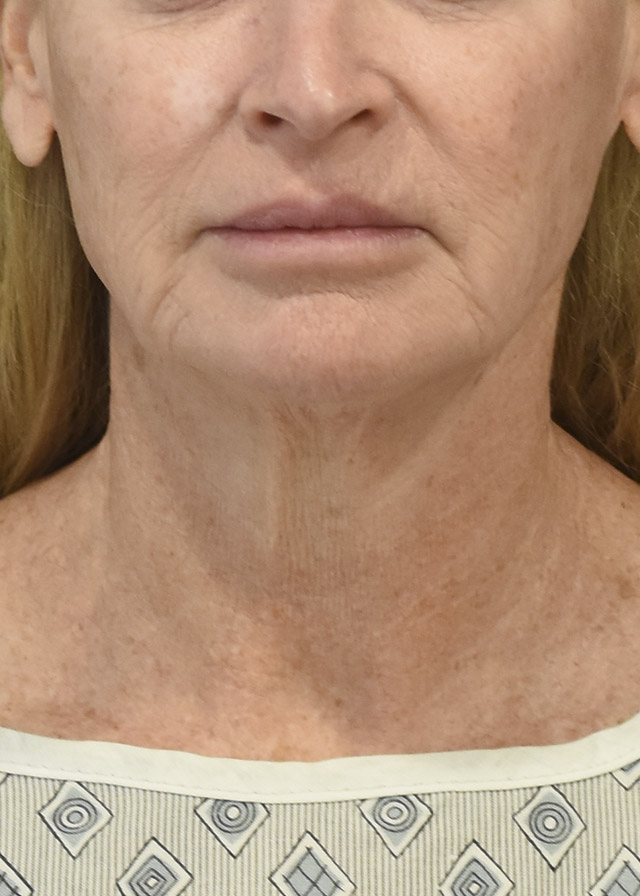 Neck Lift Patient 45 Set 1 Before