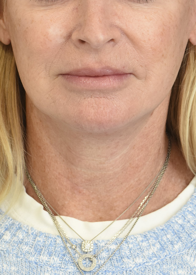 Neck Lift Patient 45 Set 1 After